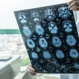 Riabilitazione delle Gravi Cerebrolesioni