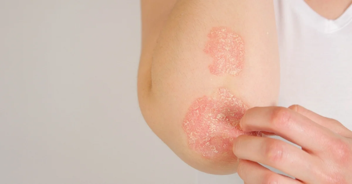 Open Day ONDA: all’Ospedale San Raffaele consulenze gratuite per psoriasi cronica grave