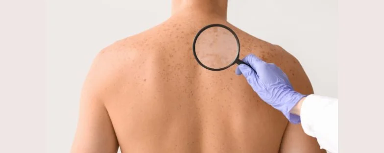 Comprehensive Cancer Center e cura del melanoma: al San Raffaele un evento gratuito su prevenzione, diagnosi precoce e trattamento