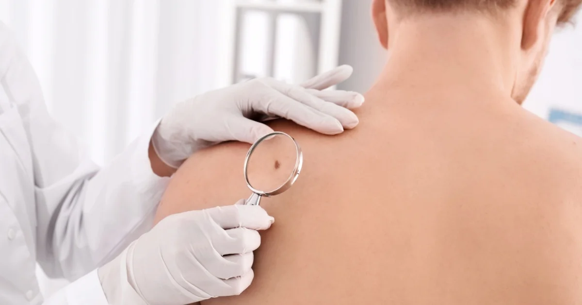 Melanoma in aumento in Italia: come riconoscerlo tempestivamente, prevenirlo e curarlo
