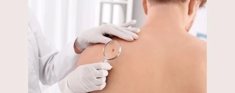 Melanoma in aumento in Italia: come riconoscerlo tempestivamente, prevenirlo e curarlo