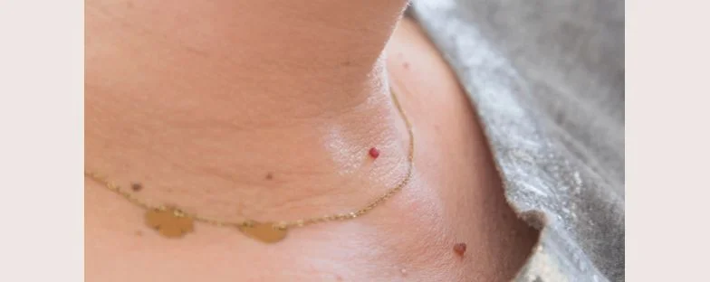 Come eliminare i fibromi penduli