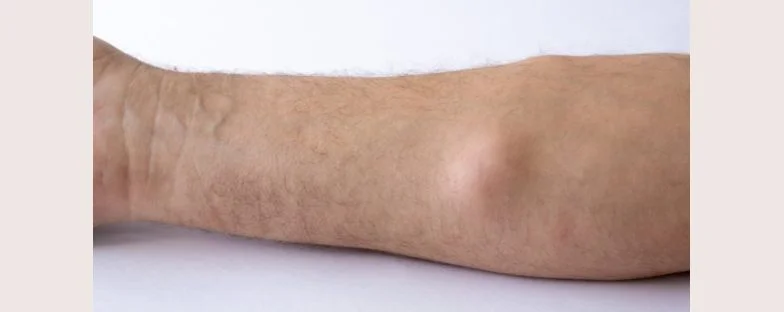 Che cos’è un lipoma e come si cura