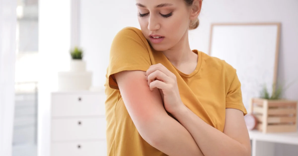 Psoriasi, cos'è e come gestirla con l’estate