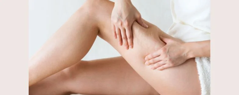 Stadi della cellulite: come riconoscerli e quali trattamenti valutare 