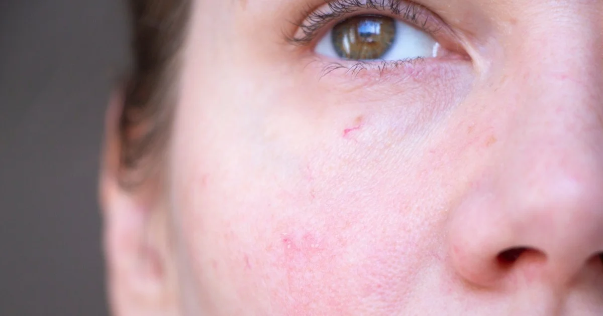 Laser vascolare: a cosa serve e come prepararsi