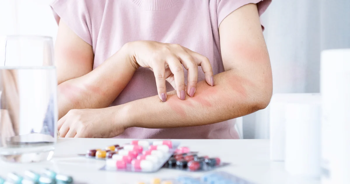 Come sapere se si è allergici ai farmaci?