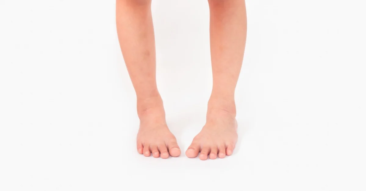Camminata con i piedi all’interno: quando preoccuparsi e cosa fare
