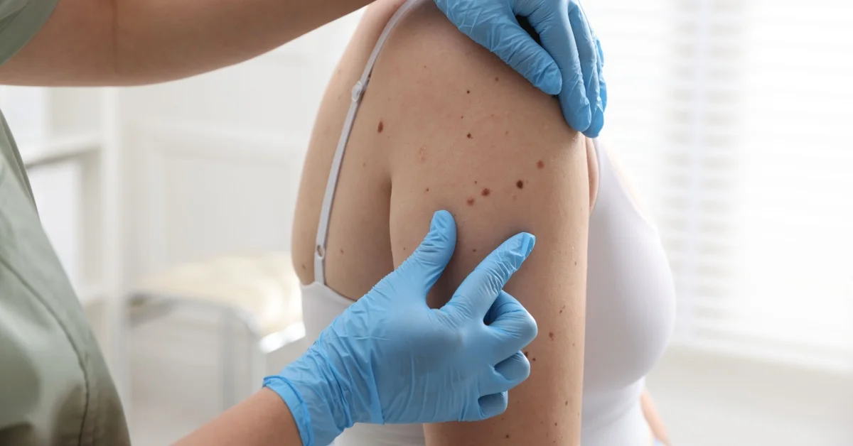 Videodermatoscopia per la diagnosi dei tumori cutanei e delle patologie dei capelli